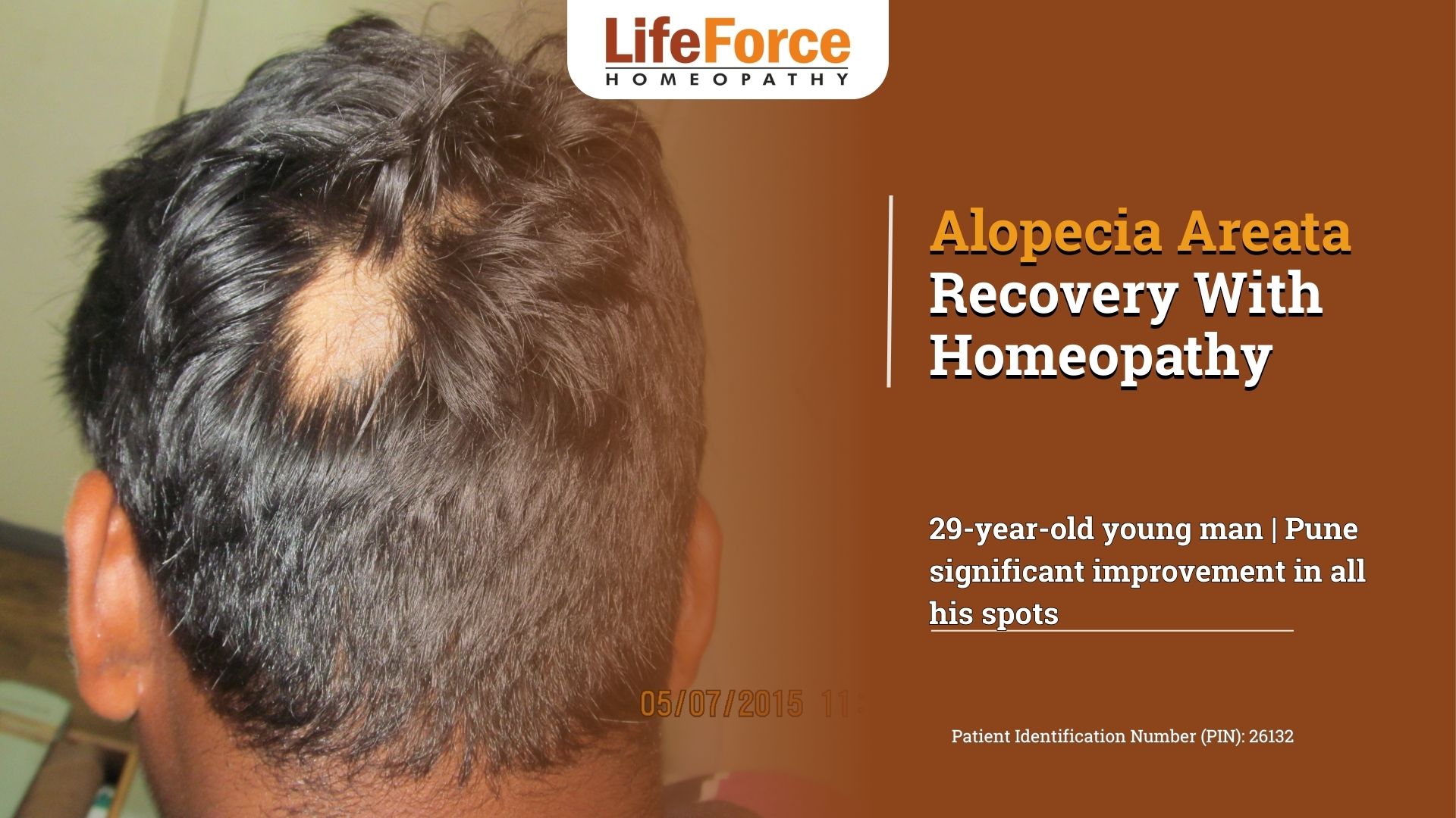 Alopecia Areata Recovery With Homeopathy 26132