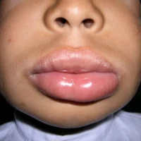 Angioedema facial swelling condition