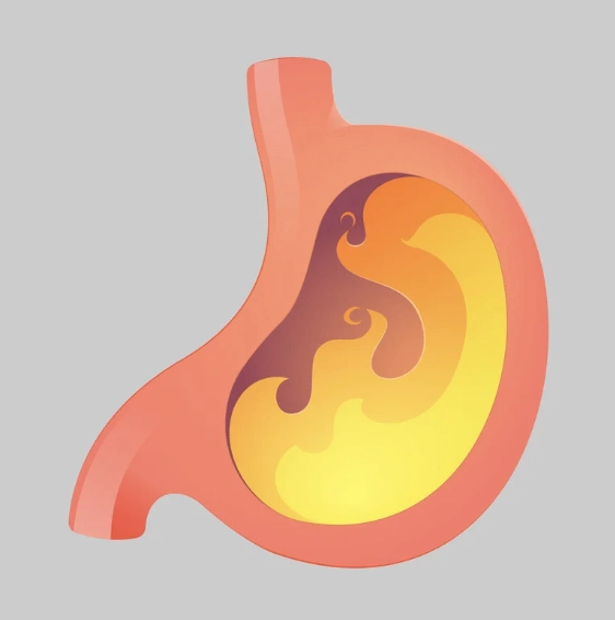 Illustration of stomach with acid buildup indicating chronic acid reflux or GERD