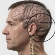 Illustration of basilar migraine showing brainstem involvement and neurological symptoms