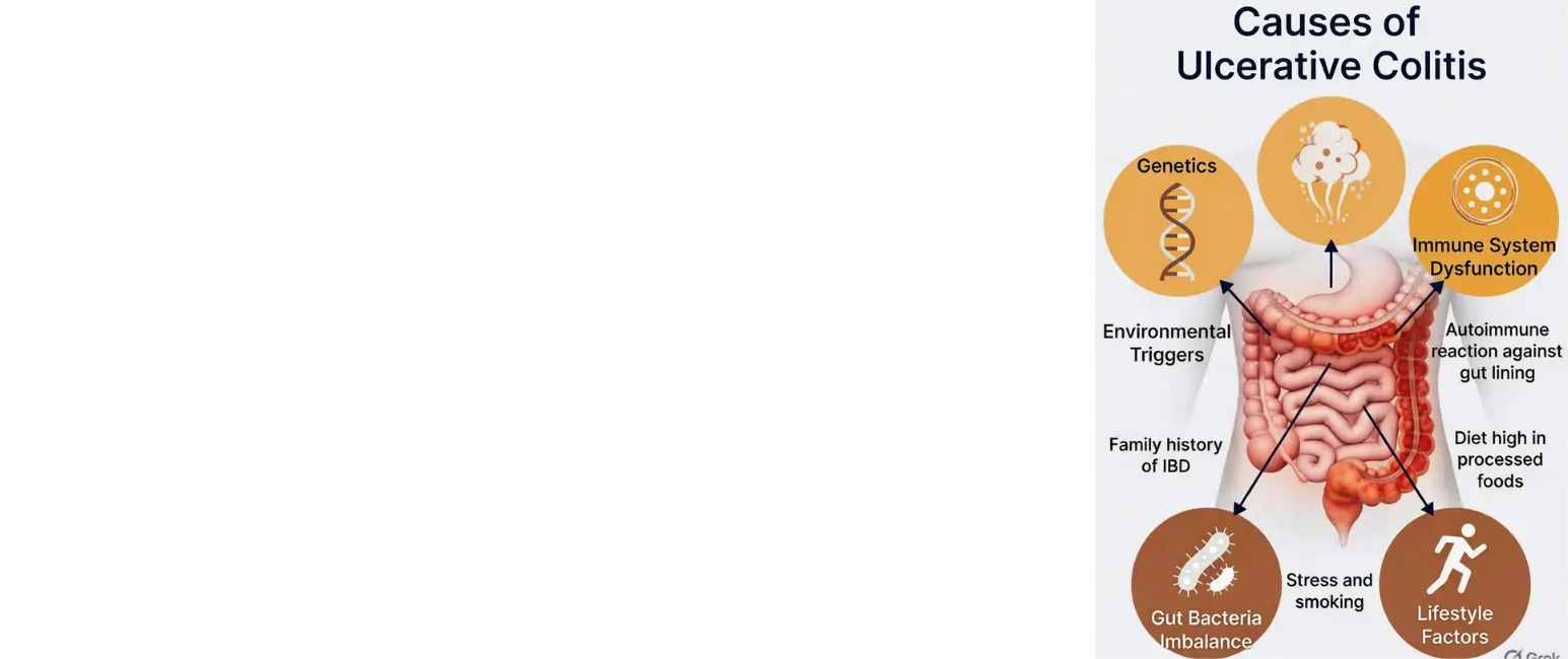 Causes fo Ulcerative Colitis