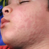 Chronic urticaria persistent hives