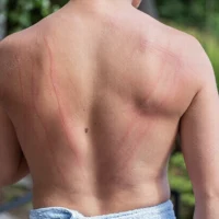 Dermatographism raised skin welts