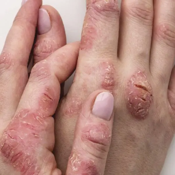 Hands with eczema showing dry, inflamed, and cracked skin patches