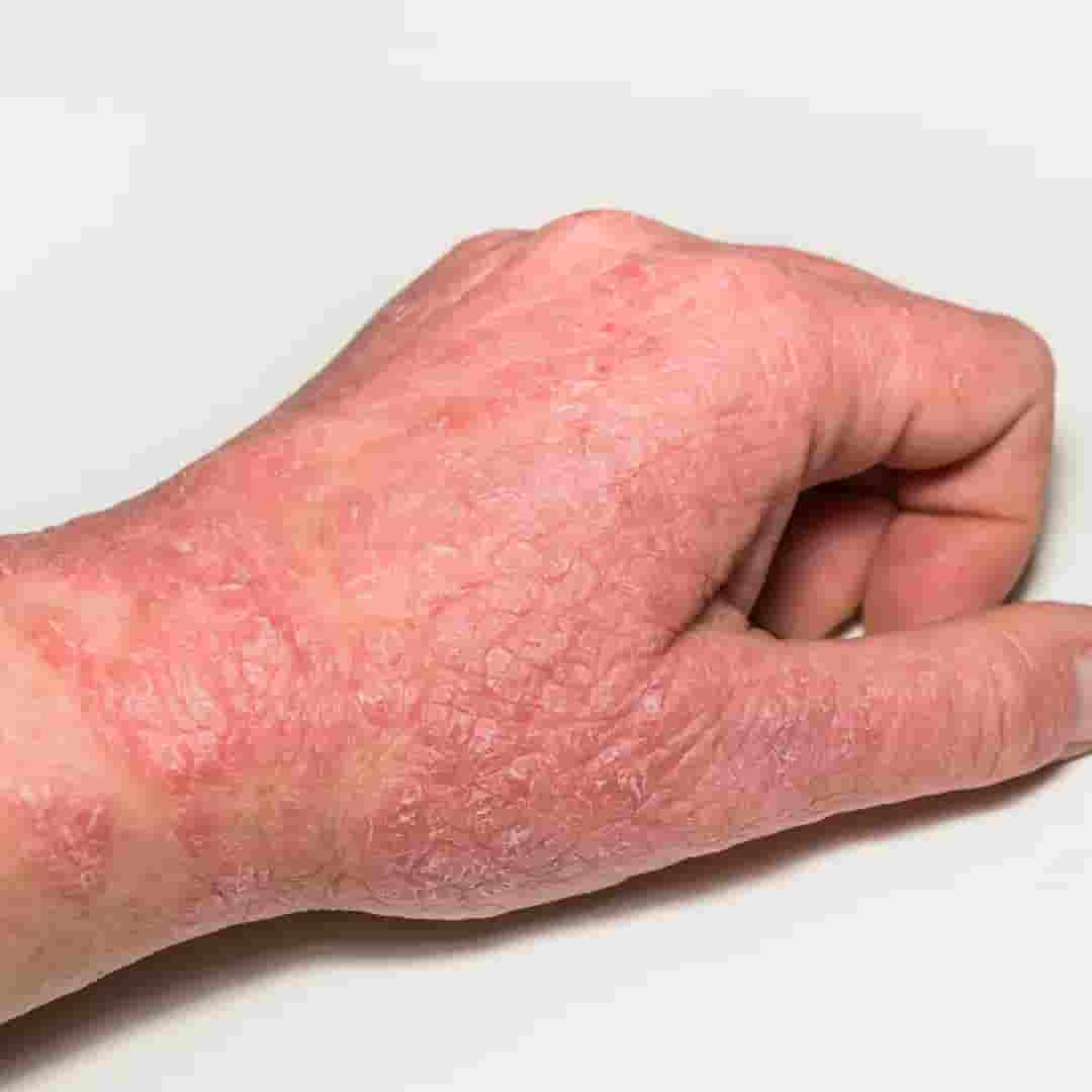 Eczema Treatment