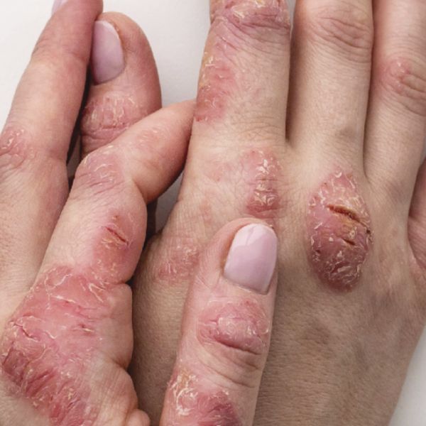 Eczema