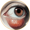 External Chalazion