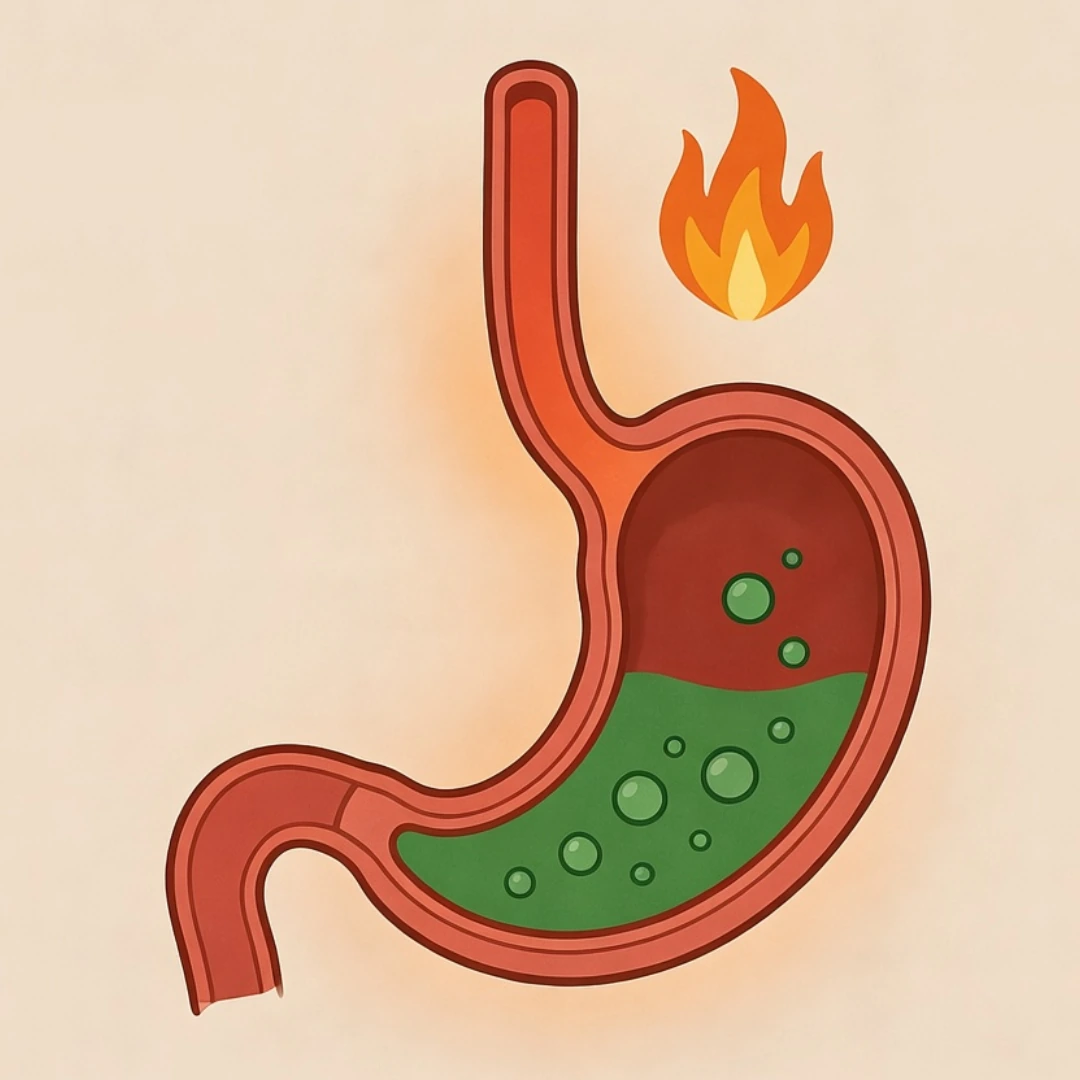 Illustration of stomach acid reflux showing acid rising into the esophagus
