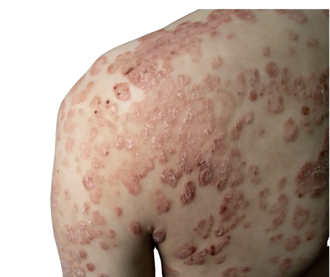 Guttate Psoriasis homeopathy treatment