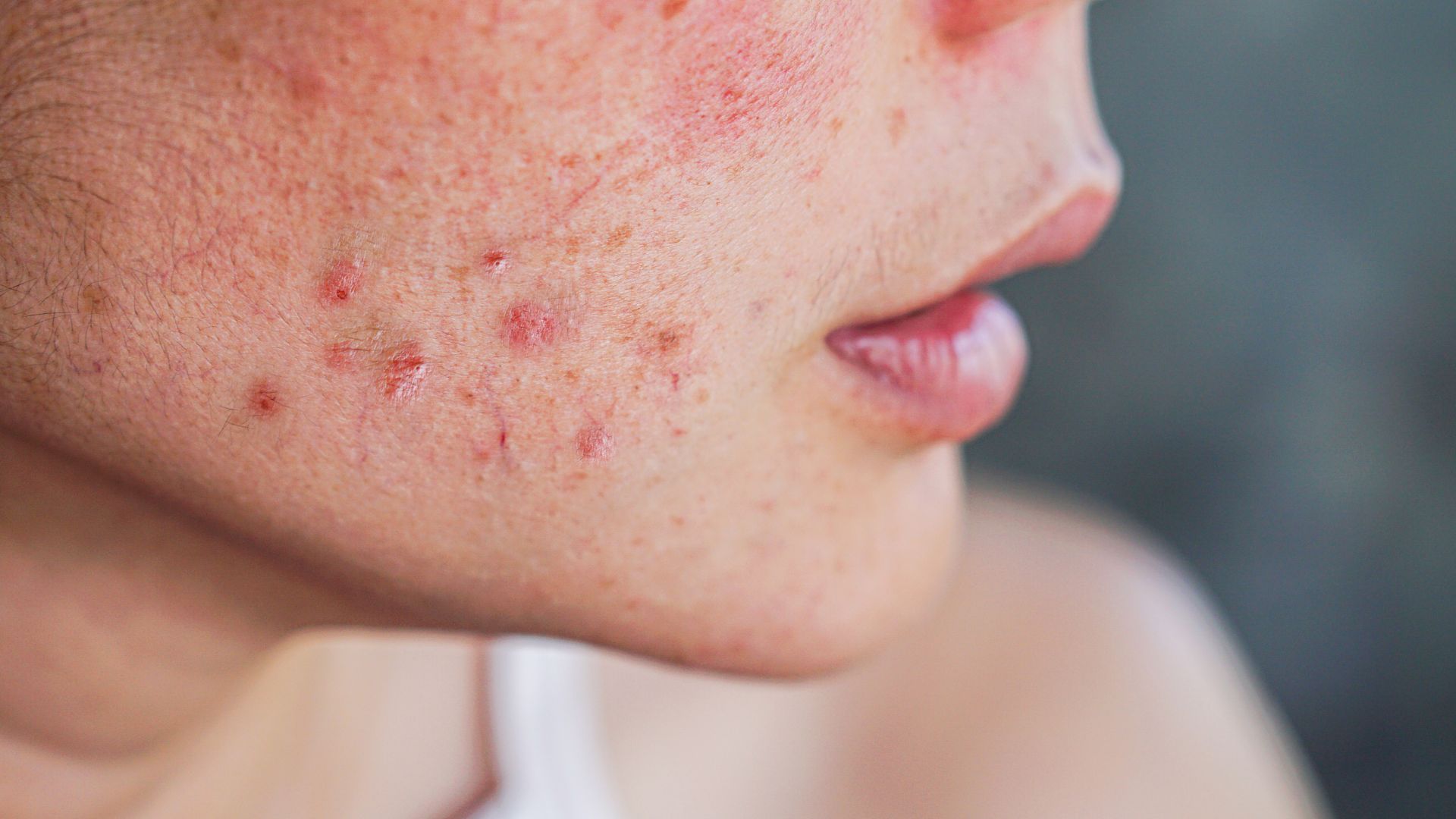 A gift of acne-free skin to a teenager from homeopathy