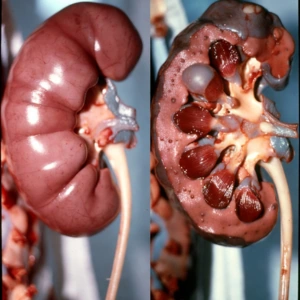 Nephrotic Syndrome