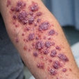 Lichen Planus