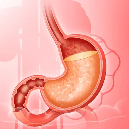 Detailed illustration of stomach showing acid and irritation related to acid reflux or GERD