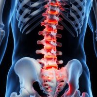 Non-Radiographic Axial Spondyloarthritis