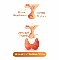 Primary Hypothyroidism