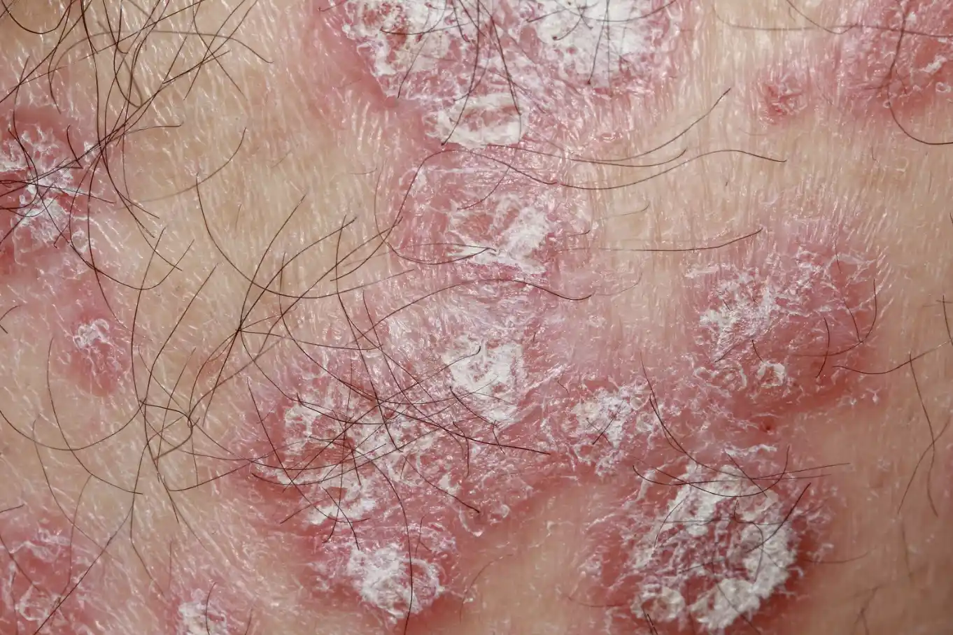Pustular Psoriasis