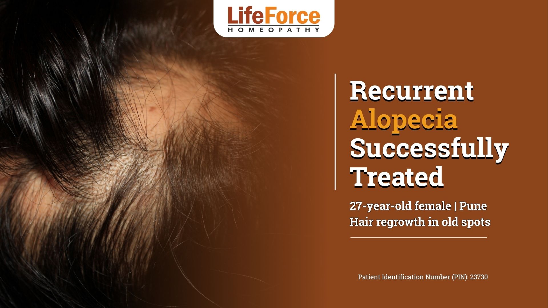 Recurrent Alopecia Successfully Treated With Life Force