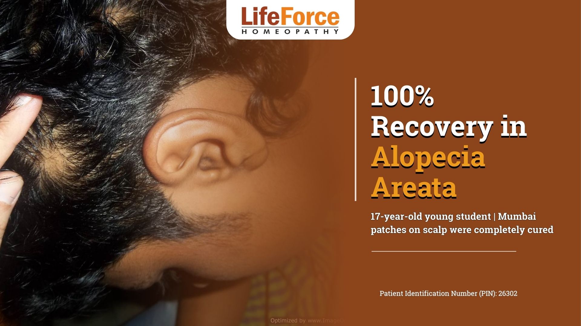 Recurrent Alopecia Successfully Treated 26302