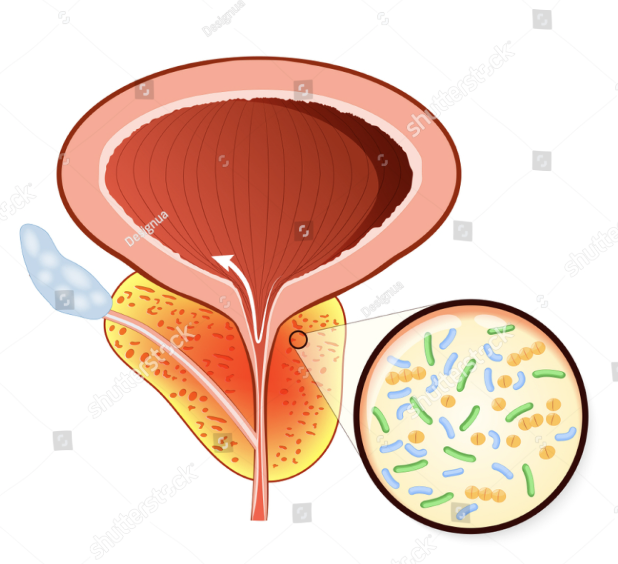 Prostate infection