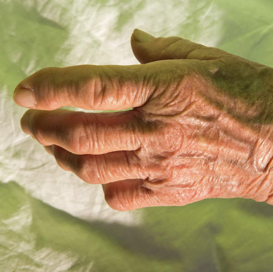 Asymmetric Psoriatic arthritis