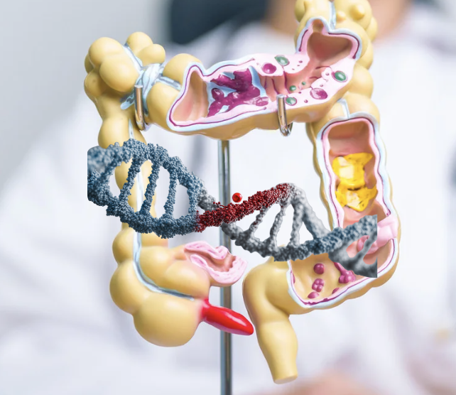 causes of Ulcerative colitis