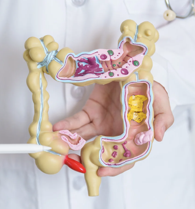 Complications of Ulcerative coltiis