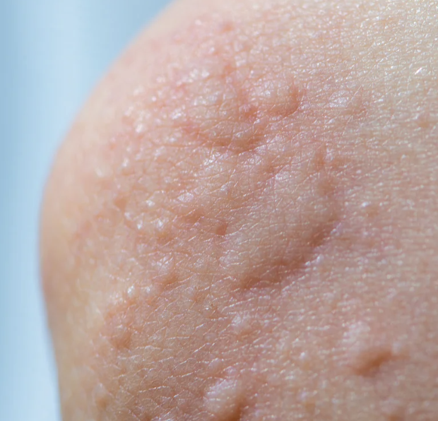 urticaria