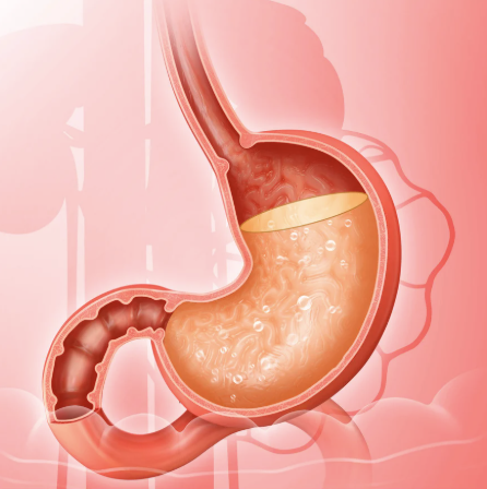 Erosive gastritis