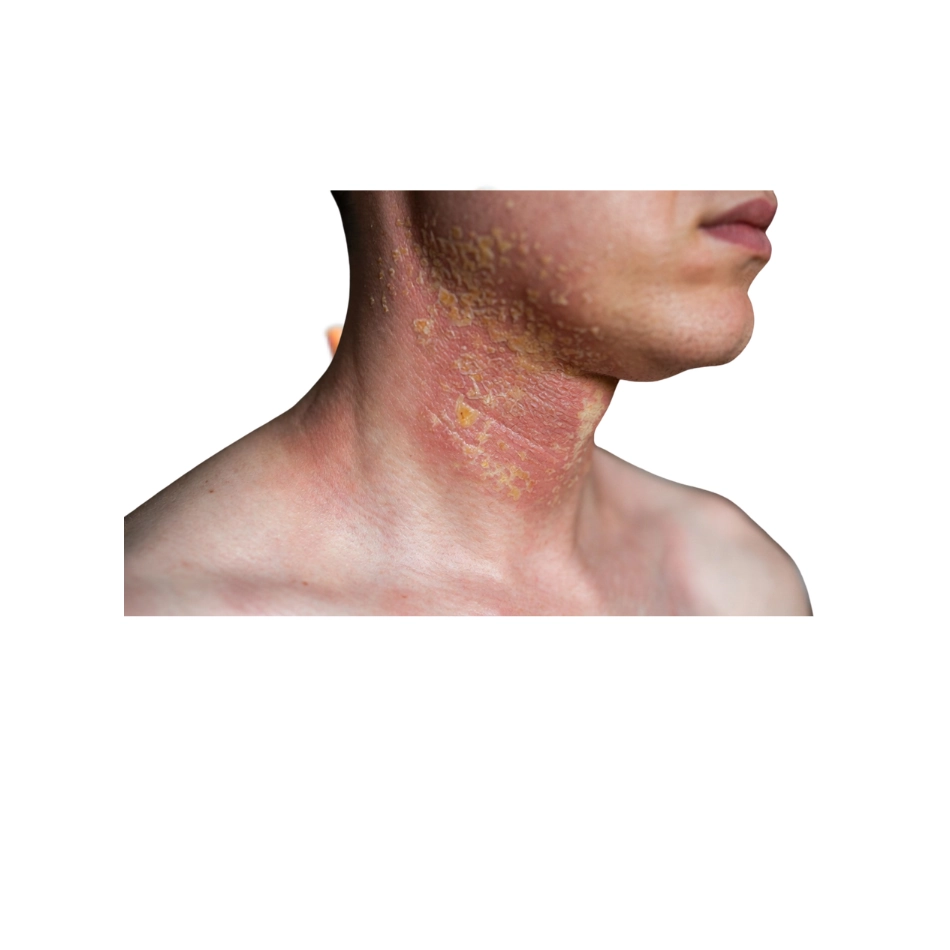 Seborrheic eczema on neck showing red, scaly, and inflamed skin patches