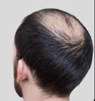 Back view of man showing hair thinning on crown area indicating hair loss