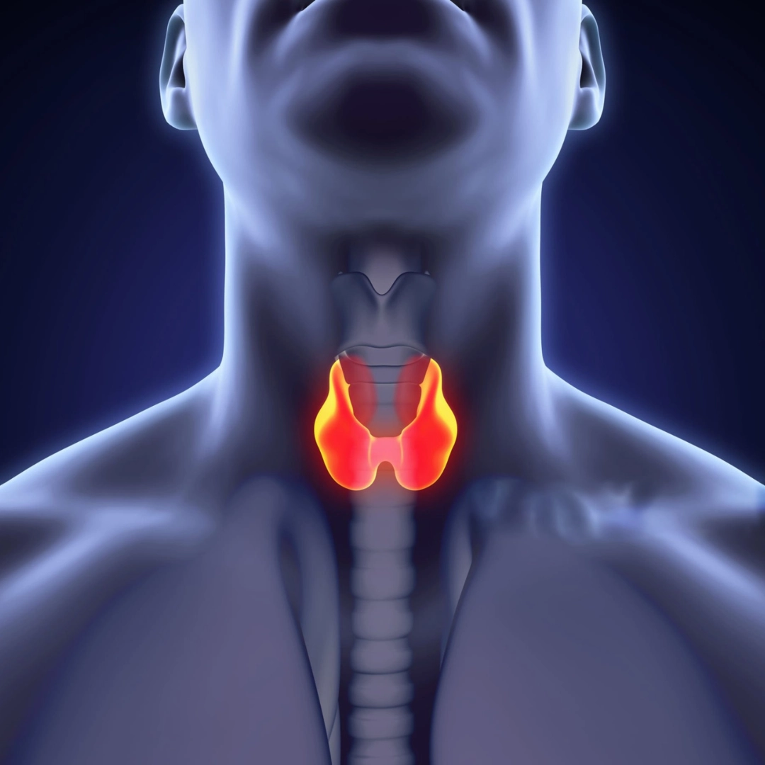 Underactive thyroid gland illustration showing reduced hormone activity
