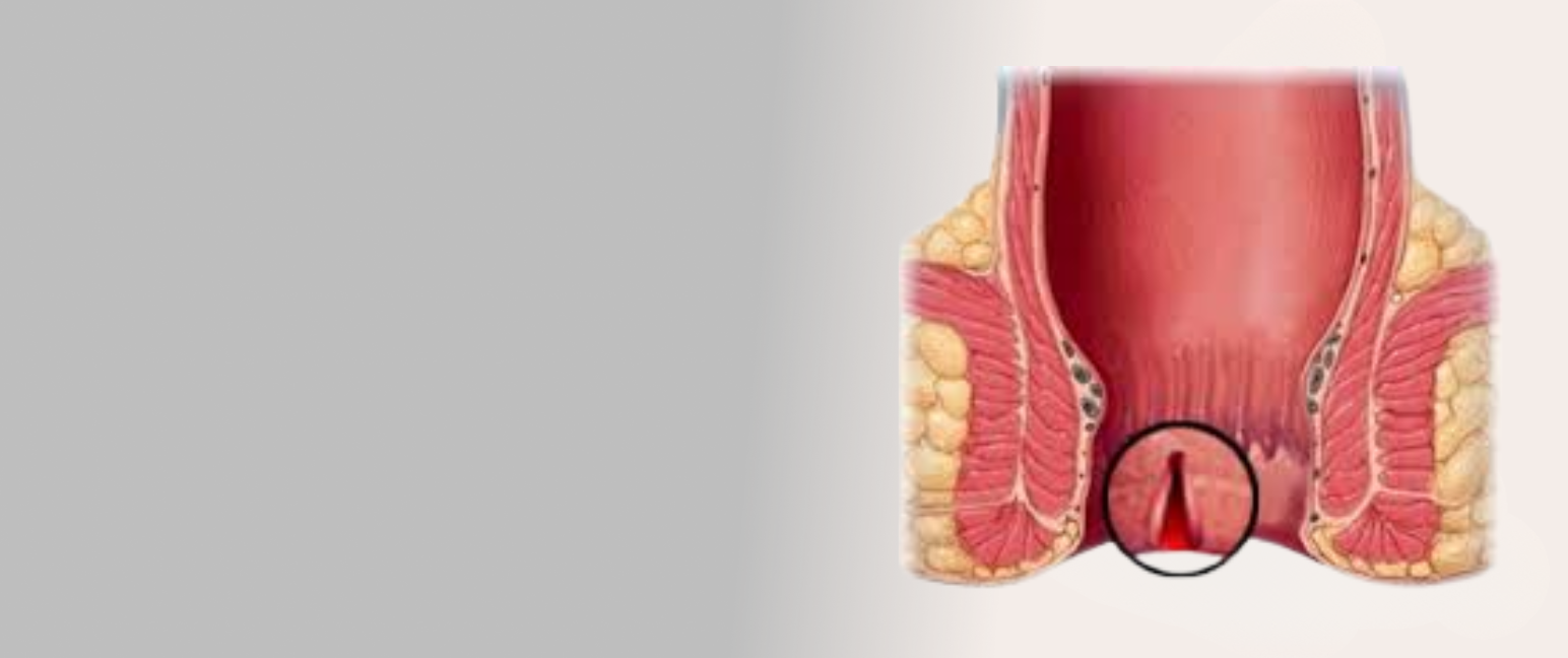 Understanding Fissure In ANO
