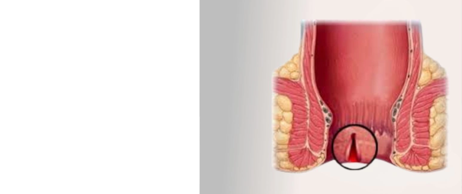 Illustration showing fissure in ano with anal tear highlighted for treatment understanding