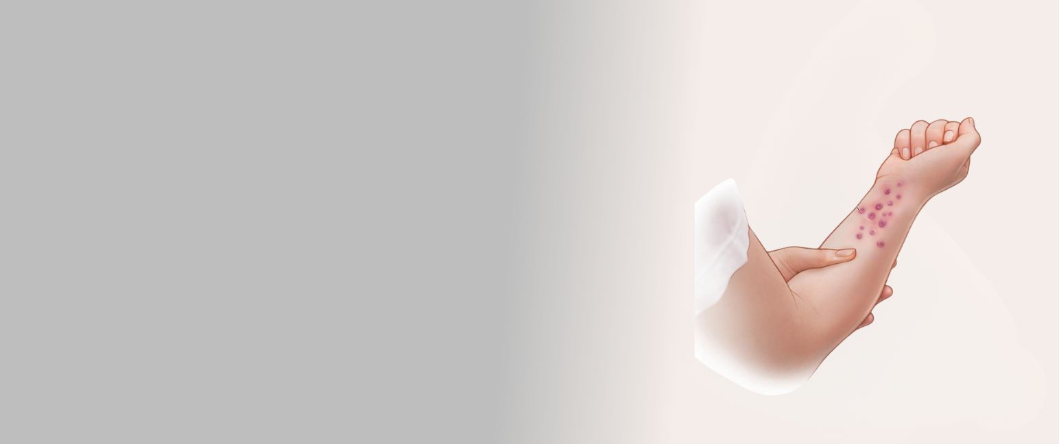 Understanding Lichen Planus