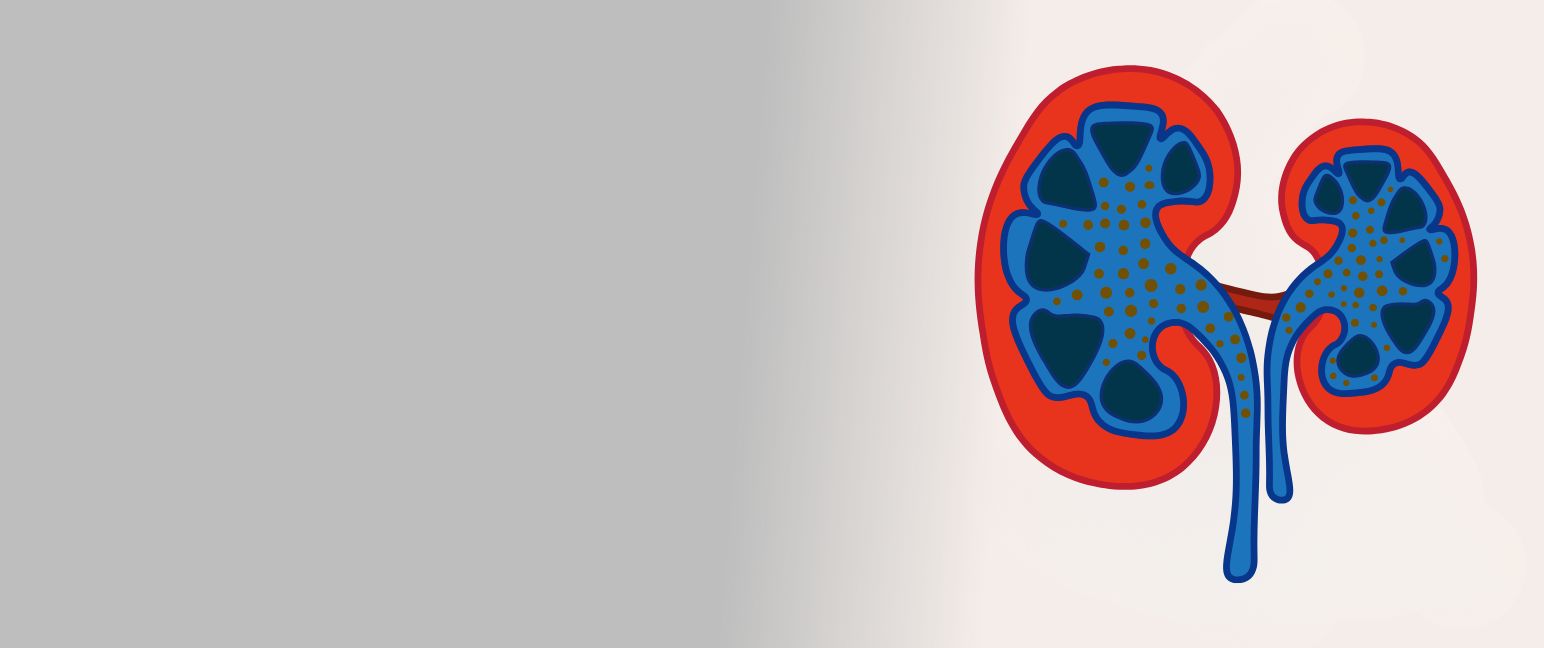 Understanding Nephrotic Syndrome