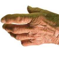 Asymmetric Oligoarthritis