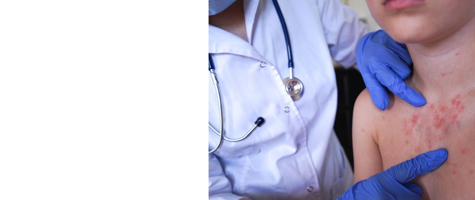 Urticaria clinical diagnosis evaluation