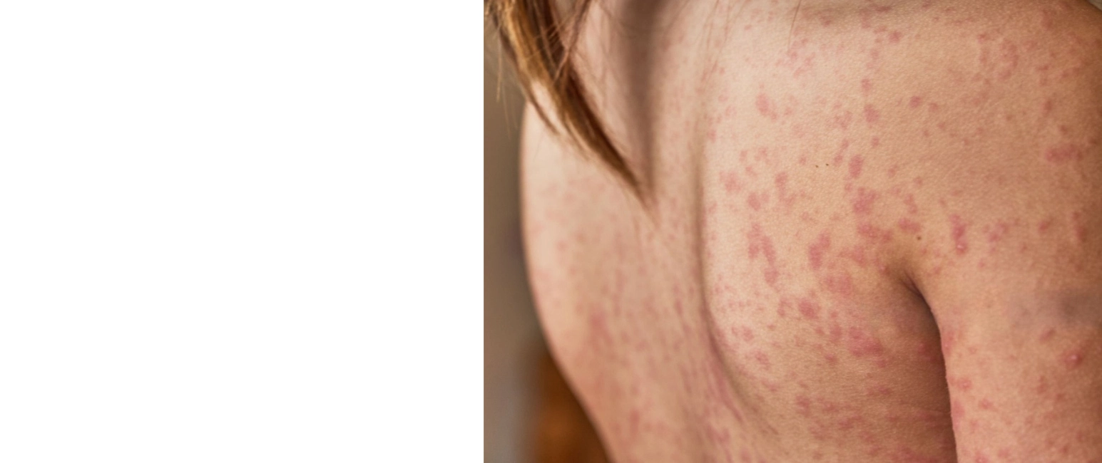 Urticaria main symptoms hives