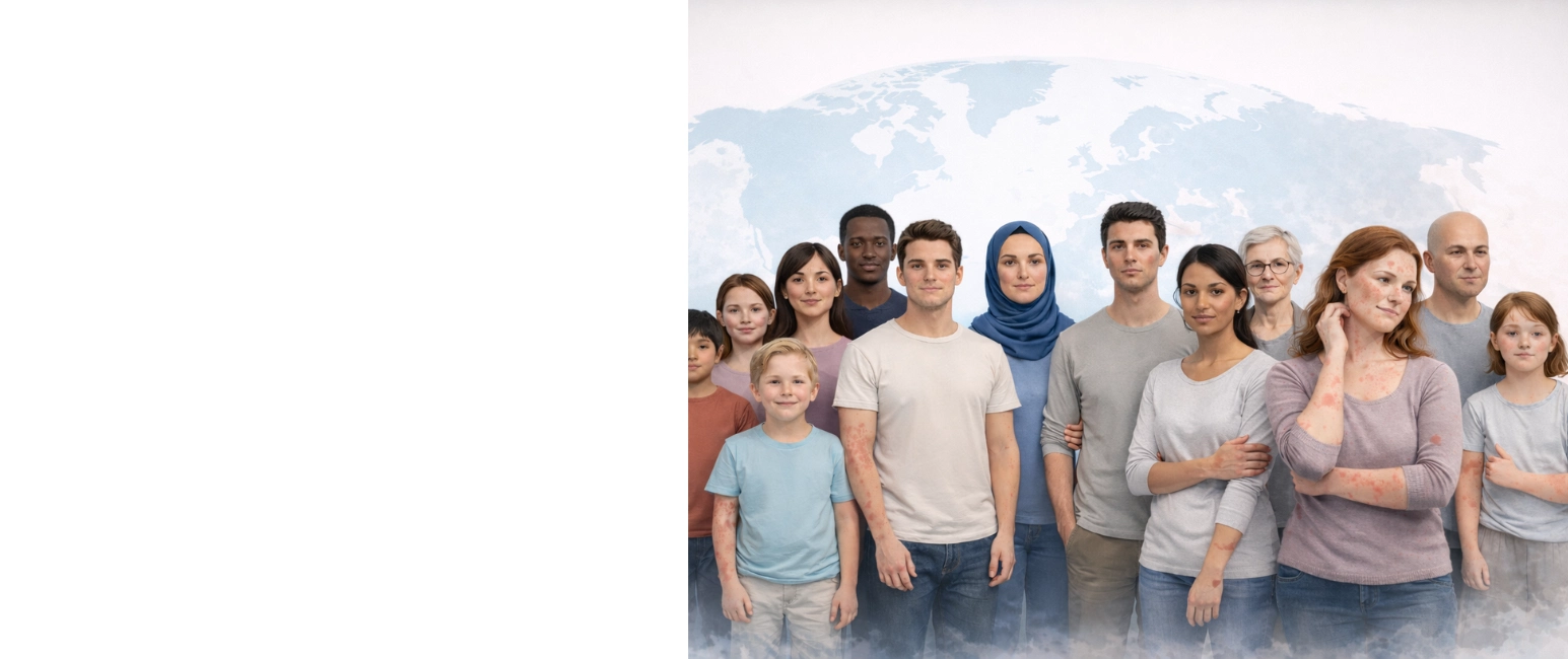 Urticaria prevalence overview