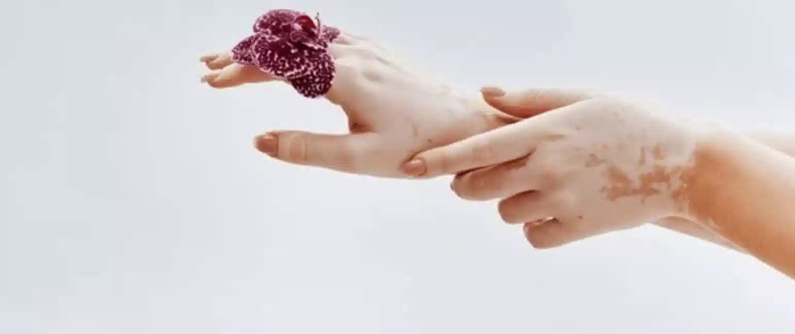 Vitiligo chronic skin condition