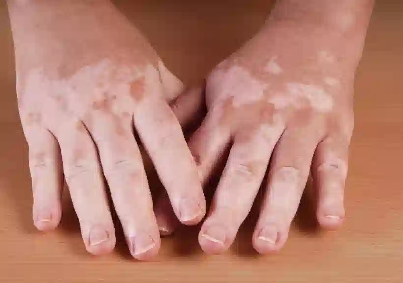 White patches on hand due to vitiligo skin condition