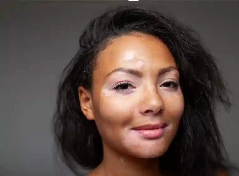 Vitiligo on face showing loss of skin