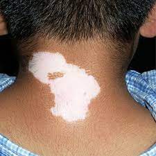 Segmental vitiligo