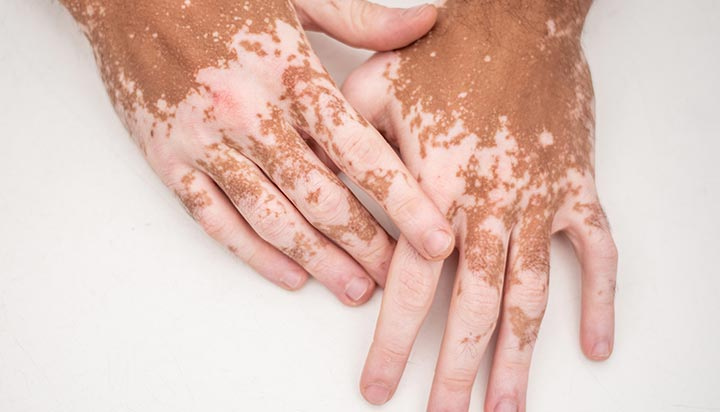 Vitiligo skin condition with white patches