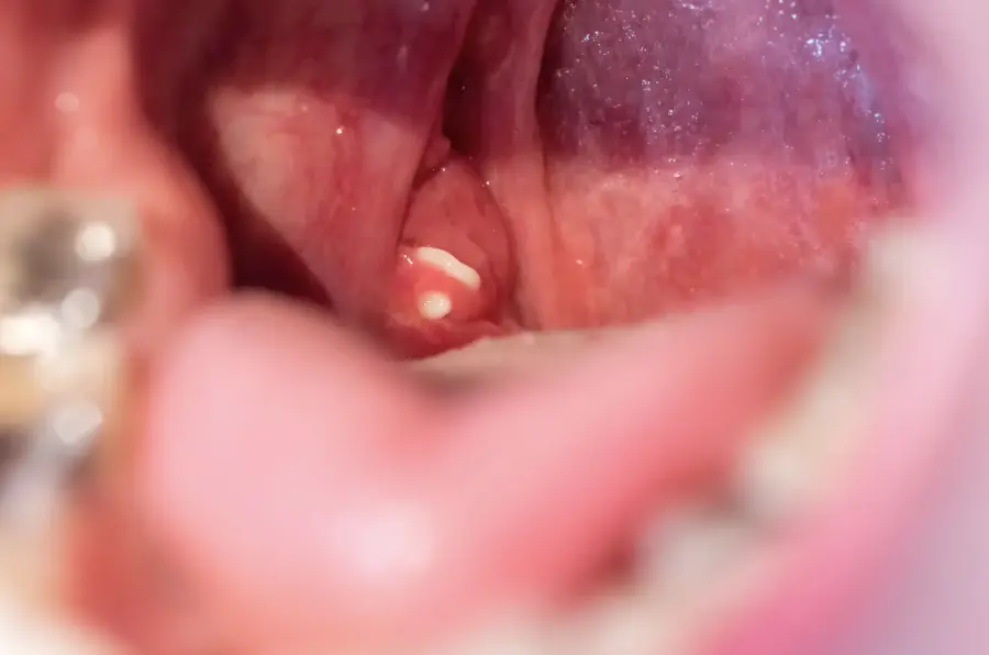 Peritonsillar Abscess