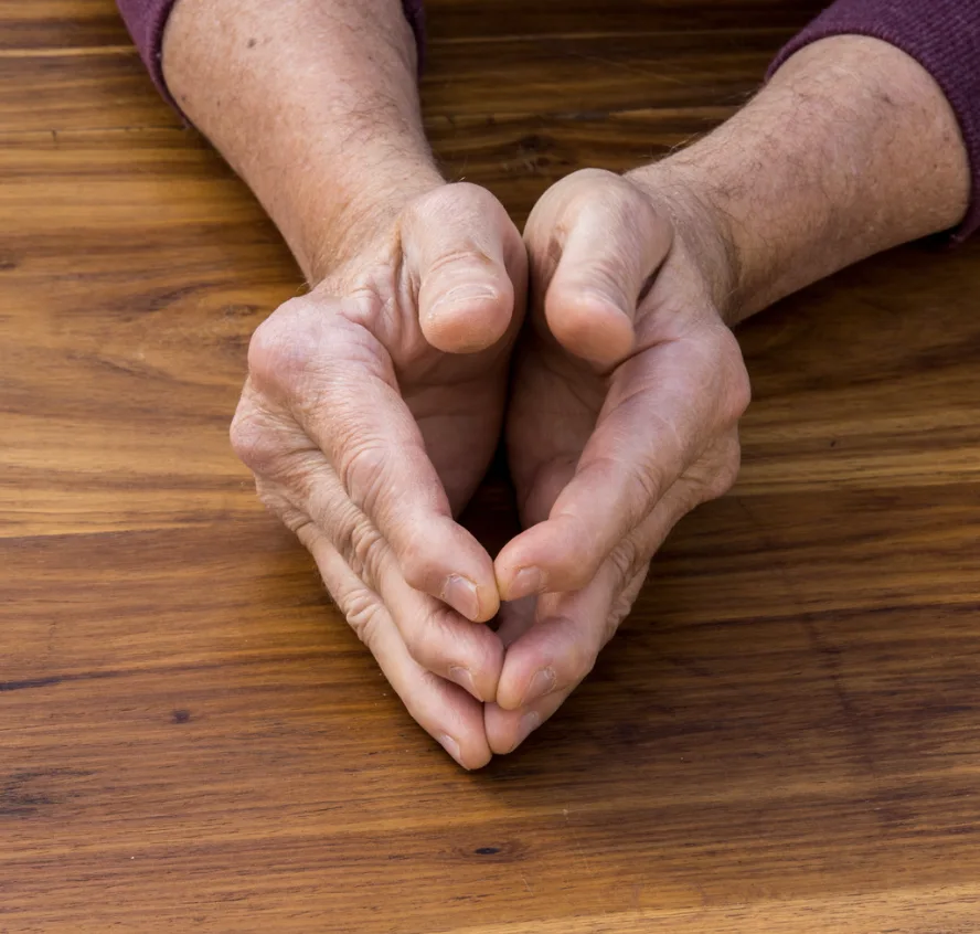 Symmetric Polyarthritis