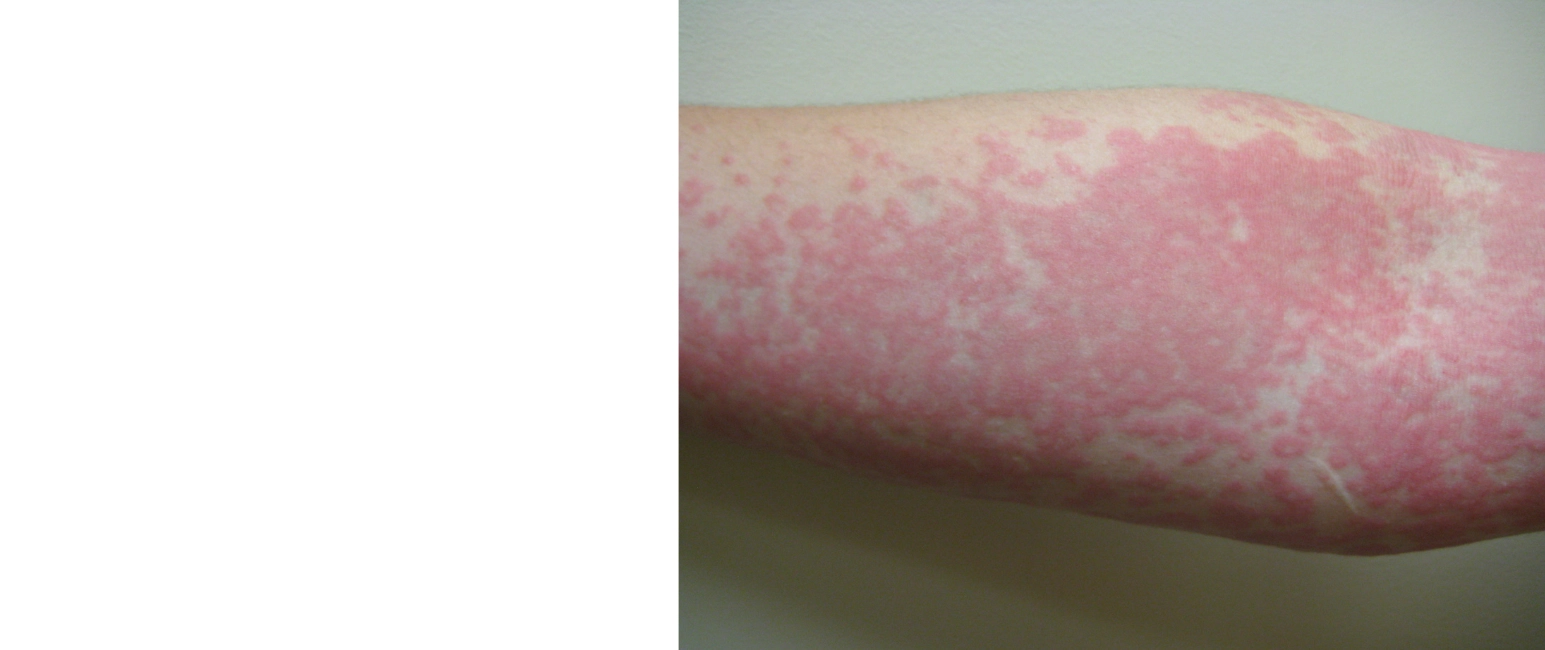 Urticaria care and management