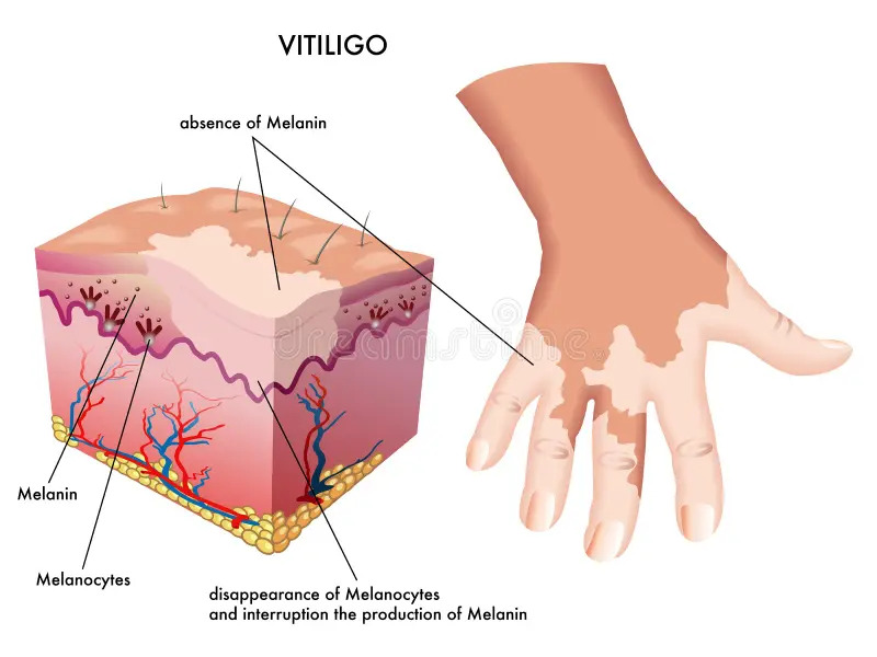 vitiligo pathology