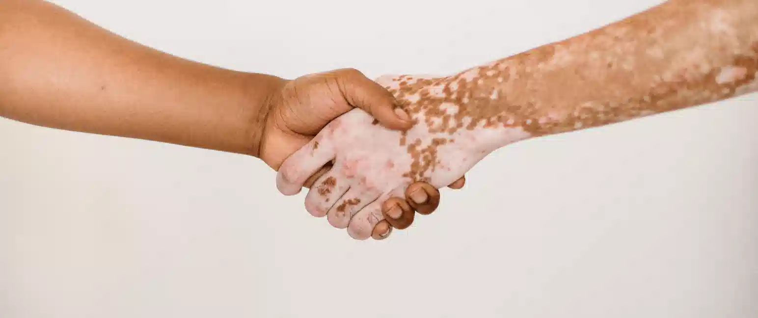 Vitiligo skin disorder illustration for educational medical awareness