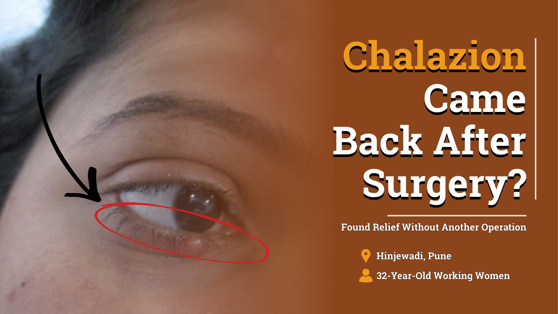Chalazion Came Back After Surgery 28098